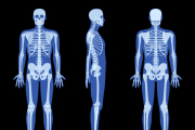La osteoporosis es una enfermedad que debilita los huesos, haciéndolos frágiles y más propensos a fracturas.